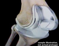 knee-replacement-sample-720676